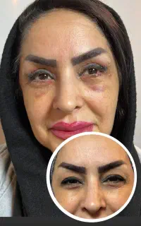 بلفاروپلاستی/افتادگی پلک