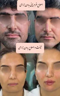 فیلر و بوتاکس بصورت تخصصی توسط پزشک در فولادشهر