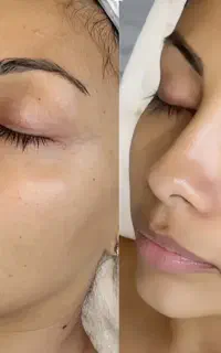 جوانسازی بدون جراحی باهایفو