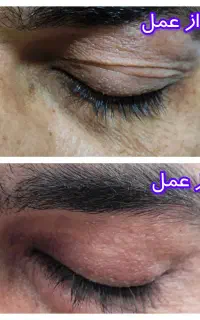 عمل های زیبائی پلک چشم (پلک بالا و پلک پائین)