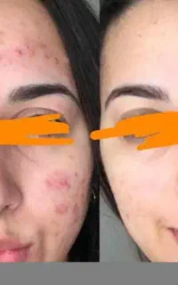 پاکسازی رایگان پوست در منزل ویژه بانوان