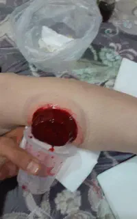 ح. جامت بهاره فصدخون و بادکش