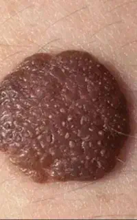برطرف کردن ریشه ای زگیل و تبخال تناسلی