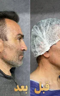 تزریق چربی صورت گندم