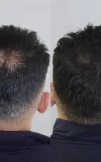 توقف فوری ریزش مو