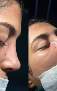 آف جراحی بینی (اهواز) فقط۲۵