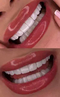 کامپوزیت،لمینت، زیبایی