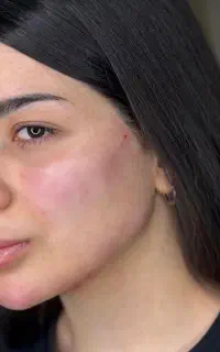 نیازمند مدل فیلر و بوتاکس در کلینیک