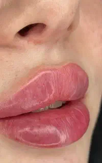 جشنواره فیلربادی  ،بوتاکس زیربغل،فیلرچشم پروفایلو