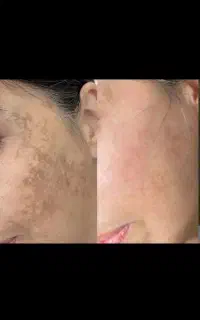 معجزه روشن سازی فوری زیربغل و بیکینی و صورت و لیزر
