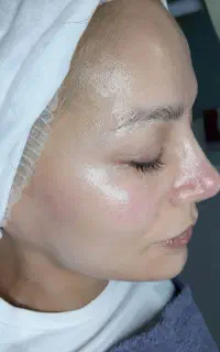 فیشال و پاکسازی پوست رودسر