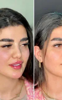 ژل مزوژل فیلر لب بوتاکس فول فیس خالبرداری