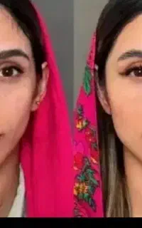 جشنواره ژل و بوتاکس زیر نظر پزشک