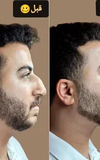 تزریق ژل صورت وبدن وبوتاکس و لیپوماتیک وخال برداری