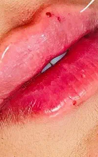 جشنواره تزریق ژل و بوتاکس در مطب ۸۹۰