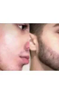 دوره درمانی جدید برای ریش