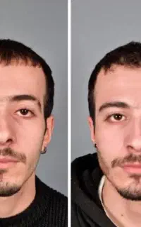 ژل کل صورت با بوتاکس رایگان 50%تخفیف «کلینک پاکدل»