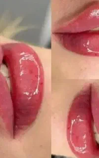 بوتاکس۷۰۰،تزریق‌ژل‌و‌بوتاکس‌‌ومزودرکلینیک‌ برق