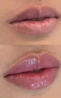 *جشنواره تابستانه*آف ژل و بوتاکس