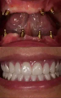 الان ایمپلنت کن ۱۲ ماهه پرداخت کن