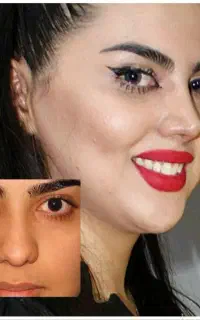 اخرین مهلت جشنواره عمل بینی با قیمت استثنایی