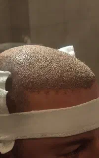 جشنواره کاشت مو شیراز