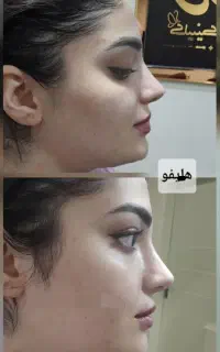 کلینیک لیفت جوانسازی هایفو سنندج (فیلرطبیعی)
