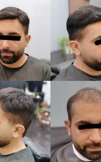 پروتز مو طبیعی کاشت مو بدون درد و نقاهت