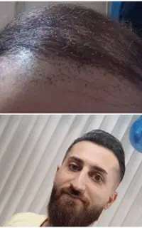 جشنواره کاشت مو