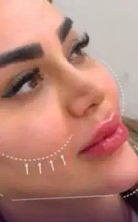 تزریق تخصصی ژل بادی ، مزو ، کانتورینگ و لیفت صورت