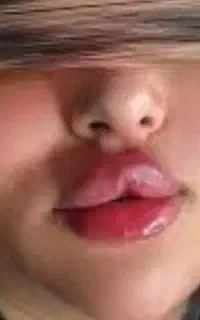 تزریق ژل و بوتاکس