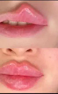 ژل‌ فیلر بوتاکس انزیم مزوژل اموزش خالبرداری فولفیس
