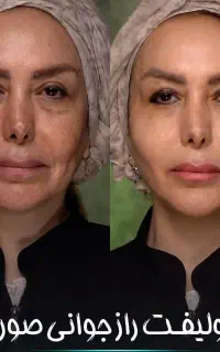 پرولیفت جوانسازی صورت بینی ابرو لب پلک شقیقه زاویه