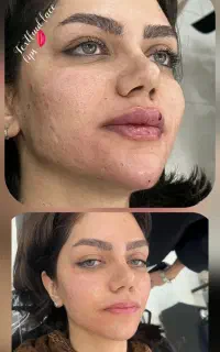 تخفیفات تکرارنشدنی ژل وبوتاکس درمطب پزشک