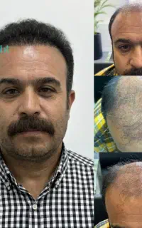 نژا کاشت مجموعه تخصصی کاشت مو و ابرو از سال 1383