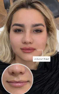 بوتاکس و ژل لب و صورت و بیکینی و باسن و هیپ دیپ