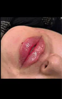 جشنواره ژل بوتاکس مزو پی ارپی  بادی انزیم درمطب
