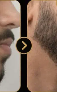 رویش مجدد ریش