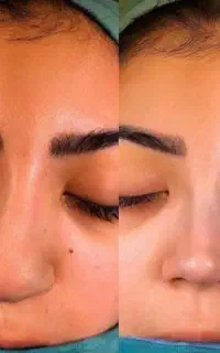 جراحی بینی اقساطی بدون سود
