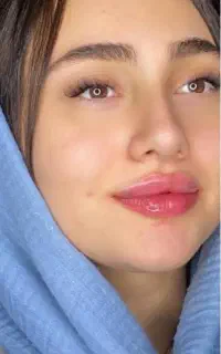 مدل رایگان تزریق ژل و بوتاکس