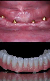 دندانپزشکی/دندان مصنوعی/اوردنچر/ایمپلنت/اقساط۱۲ماه