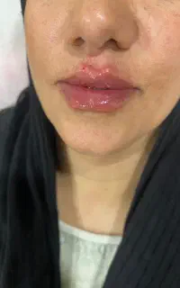 ژل هر سی سی ۲ میلیون ، آنزیم۱۵۰۰ ، بوتاکس۱۵۰۰