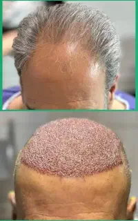 کاشت مو و ابرو طبیعی نقد و اقساط