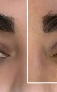 بلفاروپلاستی باروش لیزری و عمل های زیبایی