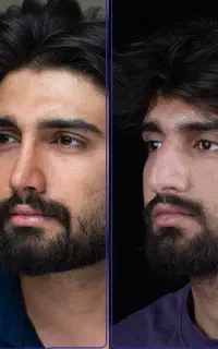 جراحی بینی با قیمت سال قبل+اقساط+مشاوره رایگان