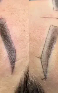 تتو و میکروبیلدینگ فیبروز