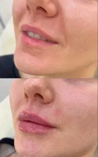 تزریق ژل و بوتاکس