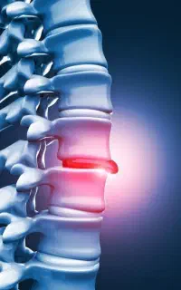 دیسک،سیاتیک و تنگی کانال نخاعی