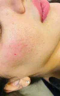 فیلر صورت سی سی ۱۳۰۰فقط تا عصر تضمینی انجام میشود