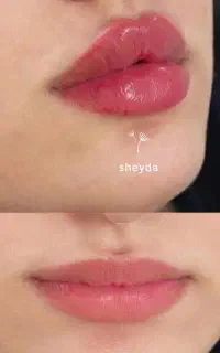 تزریق ژل،بوتاکس،خدمات تتوصورت